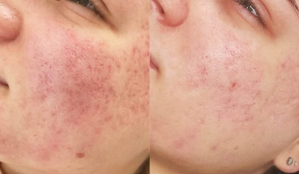 BA13_GLEAESTHETICS_DMF_CHEEKS_X5