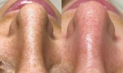 With LED Light Therapy