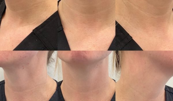 PARAGONAESTHETICS_DMF_NECK_X3_B&A